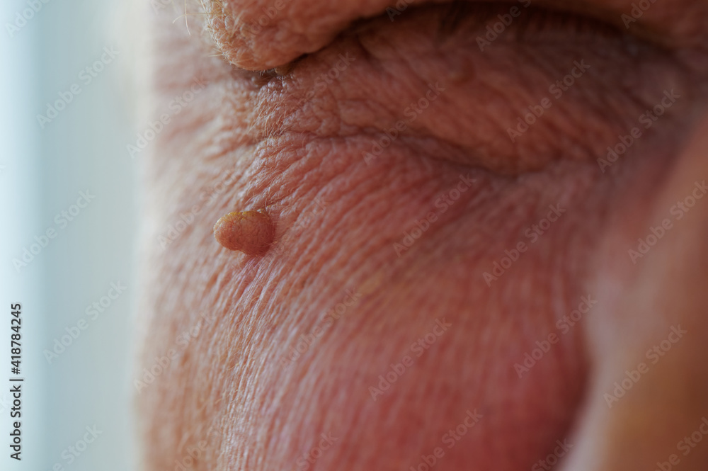 Fototapeta premium Neoplasm - human papillomavirus on the face of an elderly man, small selective depth of field, defocus, close-up of skin and pores on the surface in the upper part of the cheek