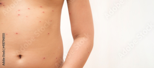 Close-up of naked body Chickenpox disease, Little girl ill with chickenpox on white background. Chickenpox virus, chickenpox outbreak in children. Concept of contagion.