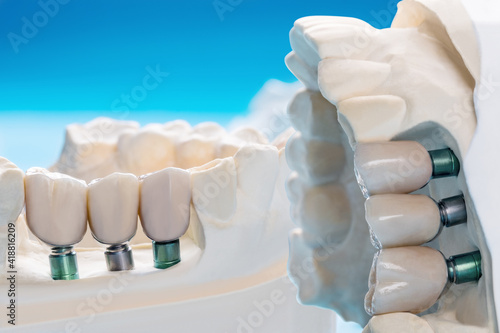 Close up Implant model tooth support fix bridge implant and crown.