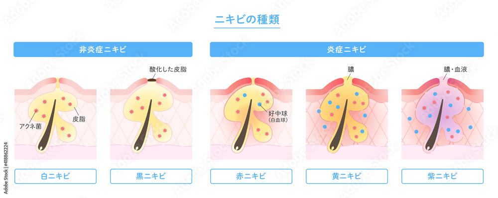 肌断面図で見せるニキビの種類のイラスト Stock Vector | Adobe Stock