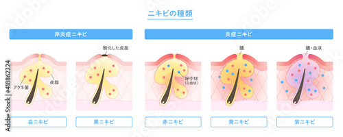 肌断面図で見せるニキビの種類のイラスト