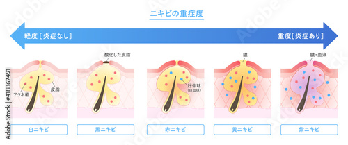 肌断面図で見せるニキビの種類と重症度のイラスト