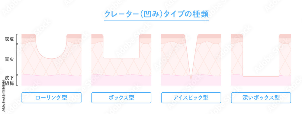 Vecteur Stock クレータータイプのニキビ跡の種類と肌断面図のイラスト Adobe Stock