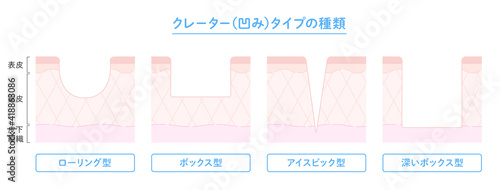 クレータータイプのニキビ跡の種類と肌断面図のイラスト