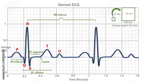 normal electrocardiogram explaining waves and intervals photo