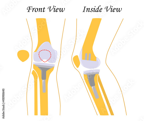 Knee replacement. Joint prosthetics. Knee endoprosthesis. Vector illustration. Flat design