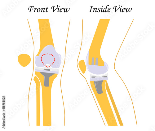 Knee replacement. Joint prosthetics. Knee endoprosthesis. Vector illustration. Flat design