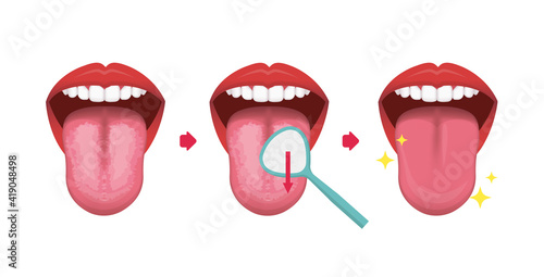 Fototapeta How to clean your tongue vector illustration (Halitosis prevention)