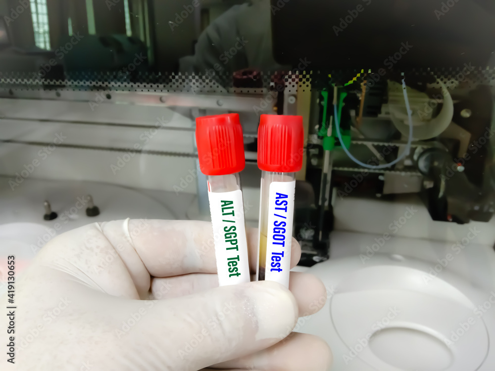 Liver figure, test tubes with blood, liver function test result are