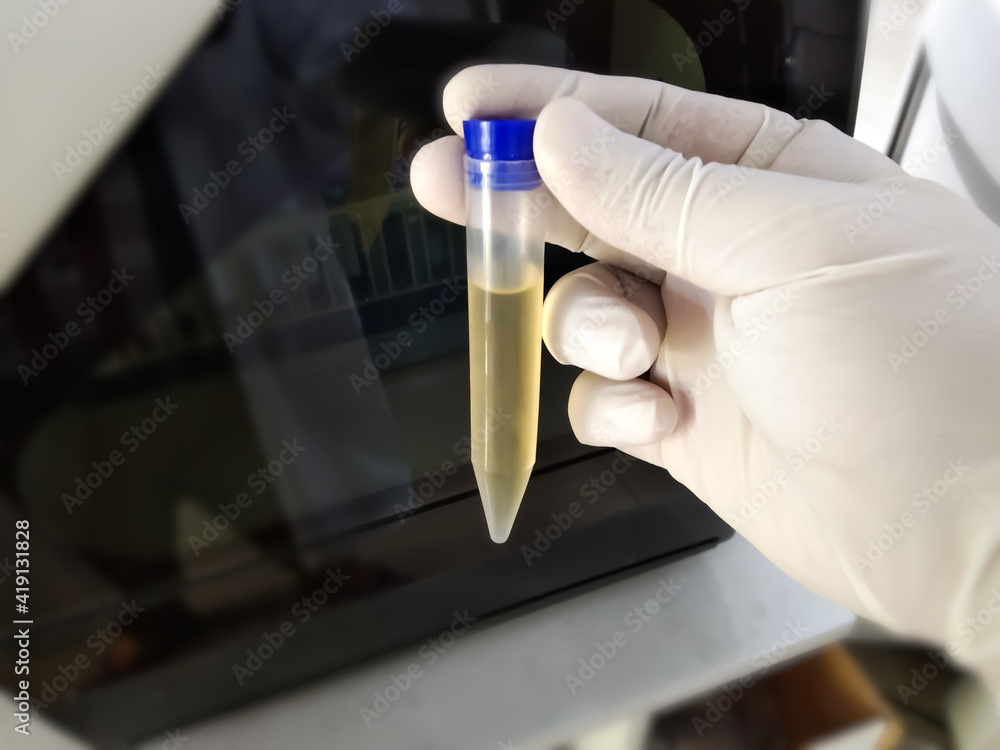 Healthcare And Medicine. Medical urine test, close-up,urine sample tube ...