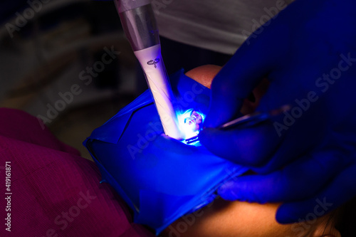 Photos Ultraviolet light in dentistry, treatment of upper masticatory teeth