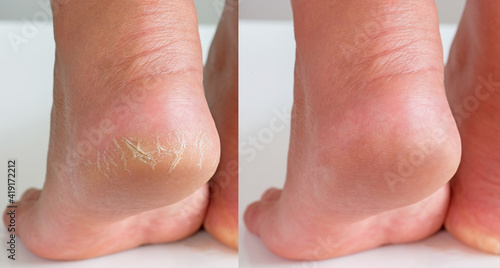 Image before and after treatment of dry heels cracks skin dehydrated skin on heels of female feet. photo