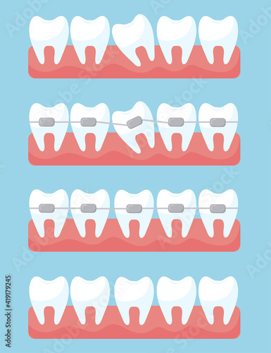 Tooth with orthodontic braces set. Illustrations of before and after treatment and correction with brackets on light blue background. Dental clinic and orthodontist services concep