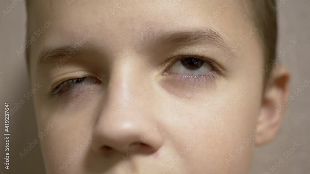 Ptosis of Upper Eyelid in Boy Long Eyelashes. Myopia. Rolling Pupil Under Eyelid Ptosis of Upper Eyelid in Boy Long Eyelashes. Myopia. Rolling Pupil Under Eyelid