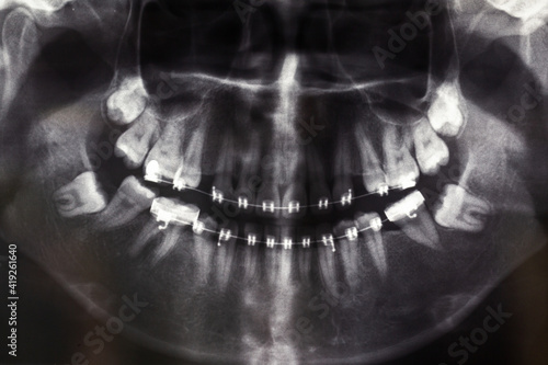 dental x ray