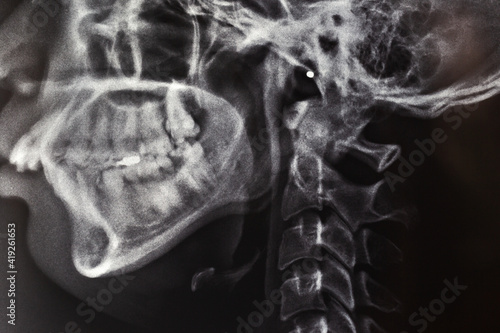 x ray image of human skull