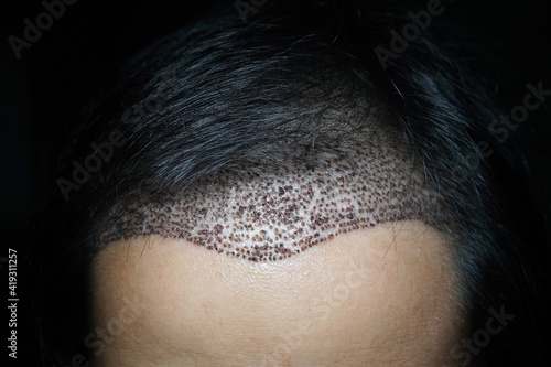 FUE hair transplant in dark environment photo