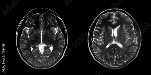 Magnetic resonance image (MRI) of normal brain, panoramic brain tomography