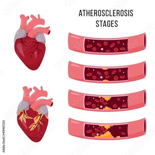 Human heart and Atherosclerosis stages.