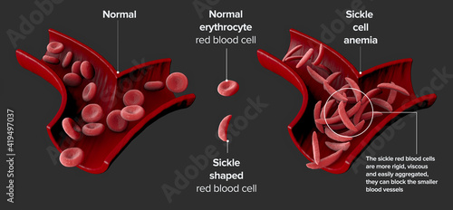 Sickle cell disease is a group of blood disorders. Sickle cell anaemia. It results in an abnormality in the oxygen-carrying protein haemoglobin found in red blood cells. 3d render photo