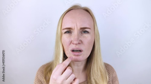 A woman examines dry skin on her lips. Peeling, coarsening, discomfort, skin sensitivity. Patient at the appointment of a dermatologist or cosmetologist. Close-up of pieces of dry skin photo