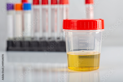 Labotatory container with human urine for medical test