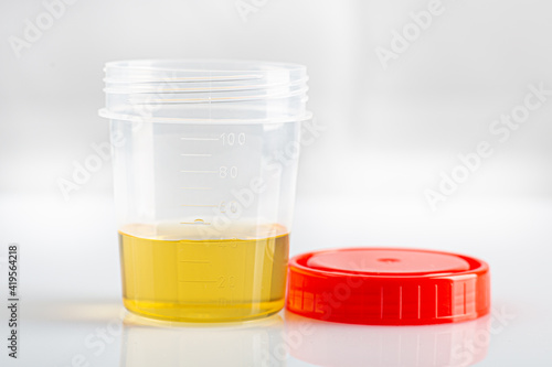 Labotatory container with human urine for medical test