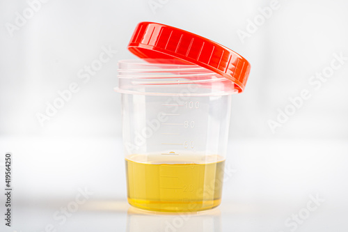 Labotatory container with human urine for medical test