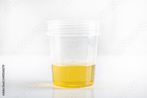 Labotatory container with human urine for medical test
