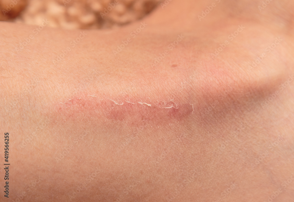 scratch on the skin of the leg as a background scratch on the skin of the leg as a background