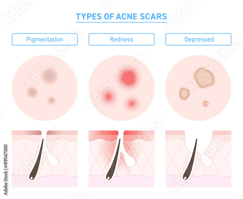 Illustration of types of acne scars