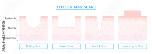 Illustration of types of acne scars