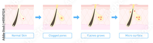 Illustration of acne formation with explanation