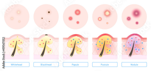 Illustration of types of acne with explanation