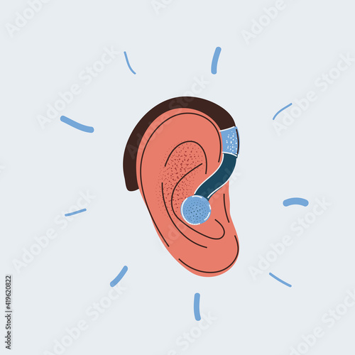 Vector illustration of hearing aid in human ear on white backround