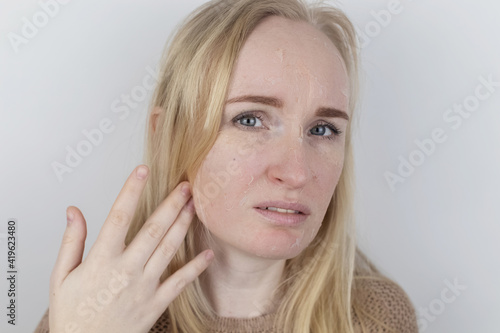 A woman examines dry skin on her face. Peeling, coarsening, discomfort, skin sensitivity. Patient at the appointment of a dermatologist or cosmetologist. Close-up of pieces of dry skin photo