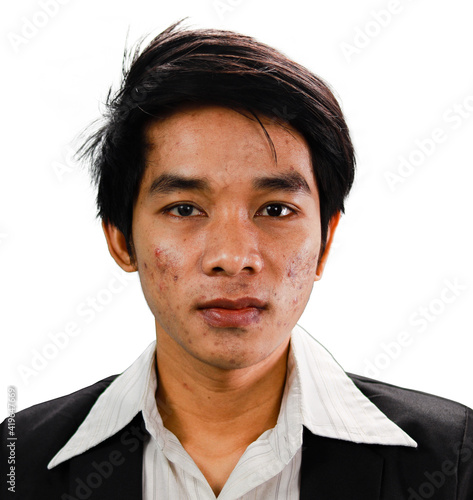 Skin disease and acne