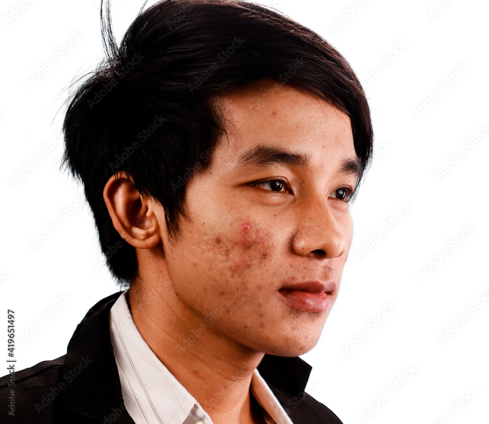 Obraz premium Skin disease and acne