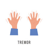 Hands with tremor symptom. Parkinson disease. Trembling or Shivering arms. Physiological stress symptoms. Mental disorders, panic, fear. Vector illustration in flat cartoon style.