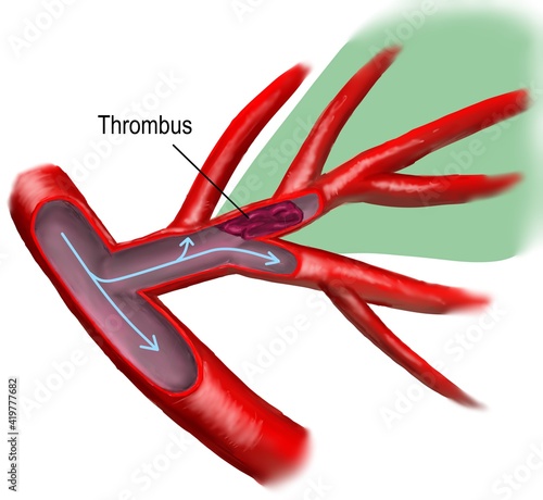 The progression of arterial thromobosis and early neurological deterioration in larcunar infarction.