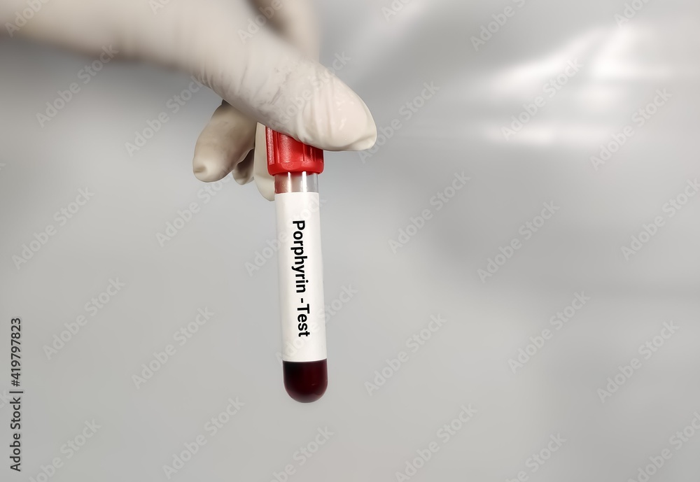 Test Tube with blood sample for Porphyrin test, neurologic porphyria. A ...