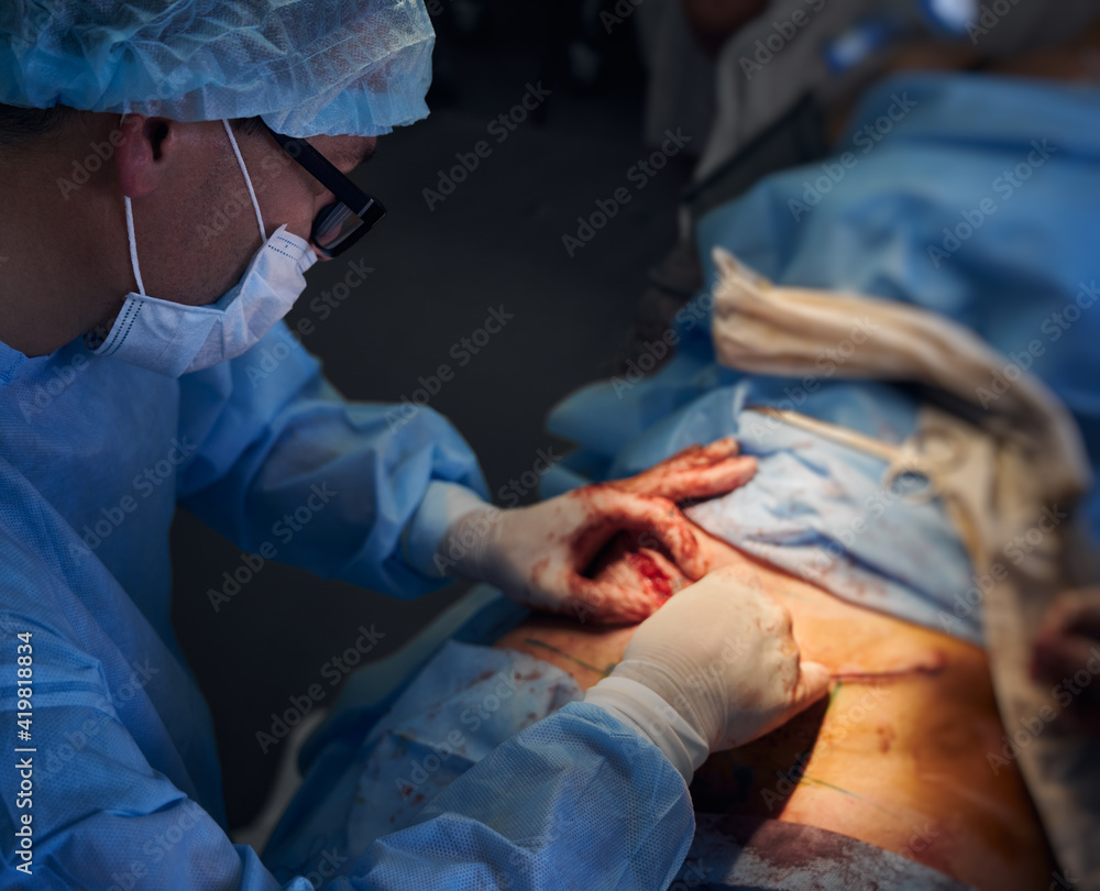 Male doctor conducting abdominoplasty surgery in operating room. Male doctor conducting abdominoplasty surgery in operating room.