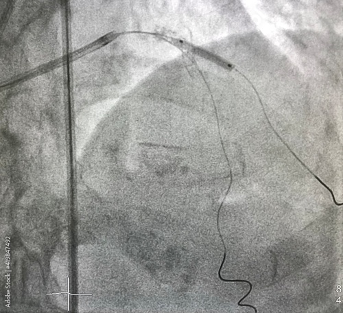 Compliant balloon catheter was inflated at proximal left anterior descending artery (LAD) to diagonal branch (DG). Coronary bifurcation percutaneous coronary intervention.
