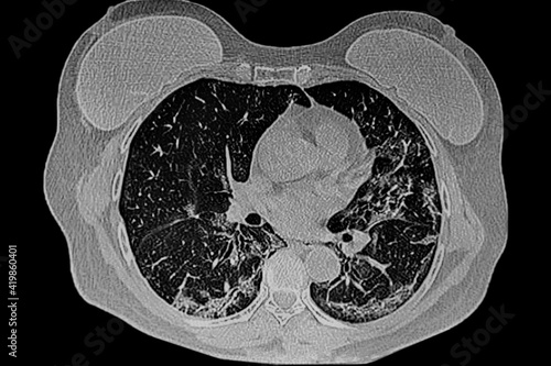 CAT SCAN of female patient with
breast prosthesis. Medicine themes
