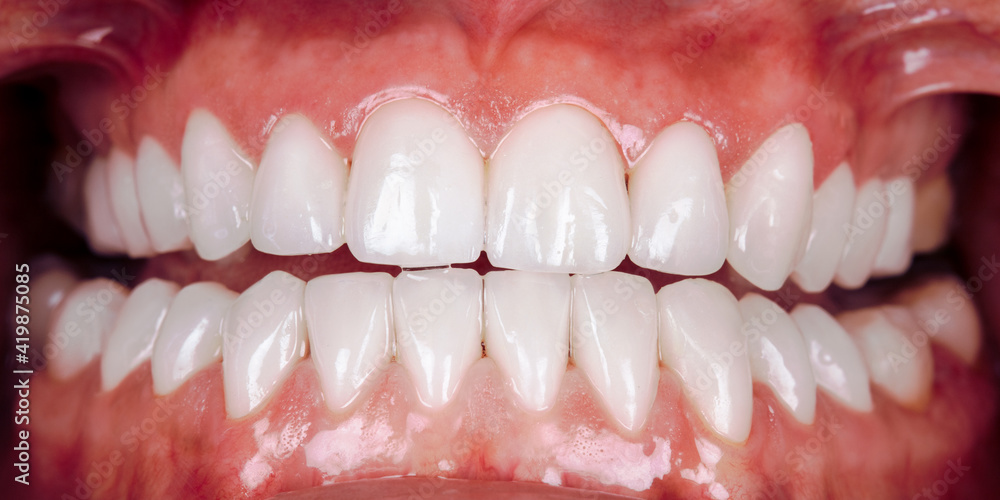 Perfect smile before and after veneers bleach of zircon arch ceramic prothesis Implants crowns. Dental restoration treatment clinic patient. Result of oral surgery procedure whitening dentistry Perfect smile before and after veneers bleach of zircon arch ceramic prothesis Implants crowns. Dental restoration treatment clinic patient. Result of oral surgery procedure whitening dentistry