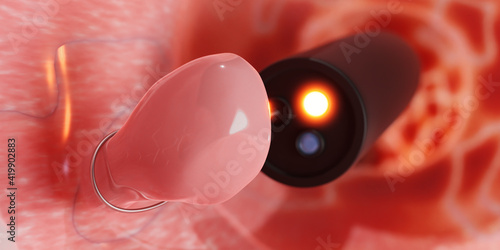 Colon Polyp Removal. Endoscope inside colonoscopy for Colon polyps search. 3d render. photo