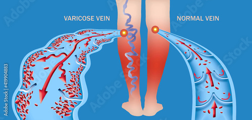Varicose veins on a female senior legs. The structure of normal and varicose veins.