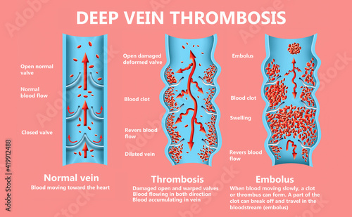 Deep Vein Thrombosis or Blood Clots. Embolus.