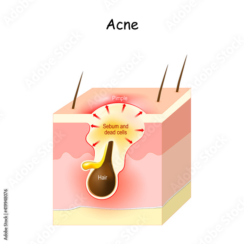 Acne Formation. Papule and pimple