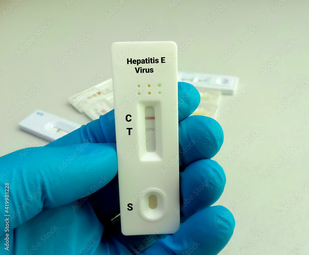 Close view of technician or technologist hand hold a device of Hepatitis E virus rapid screening test, showing positive result Close view of technician or technologist hand hold a device of Hepatitis E virus rapid screening test, showing positive result